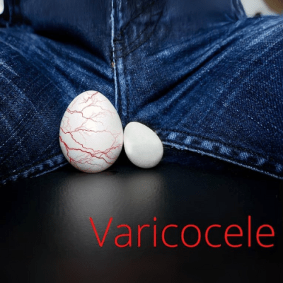 VARICOCELE: Varices genitales que afectan a la fertilidad y al placer