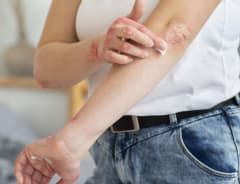 Simple Tallow y psoriasis: descanso natural para la piel