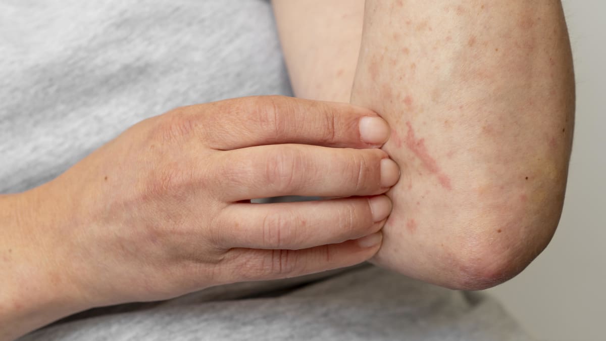 Dermatitis: nutrición y calma con Simple Tallow