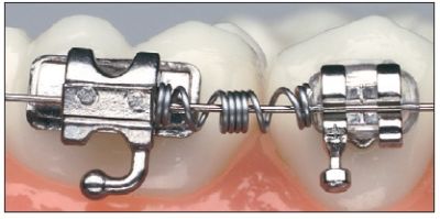 Resorte NiTi Distalizing