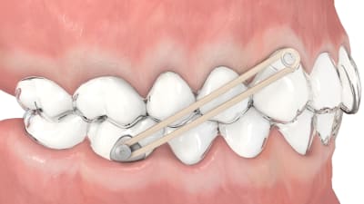 Botón de precisión Metálico Mini