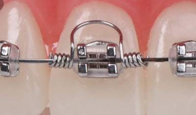 Resorte de torque; Warren