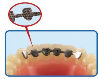 Retenedor lingual USA.
