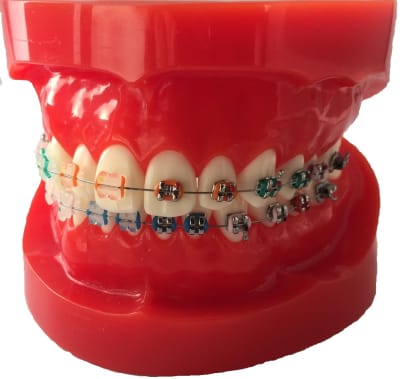 Modelo Ortodoncia  Mitad Brakets Metálicos y Cerámicos