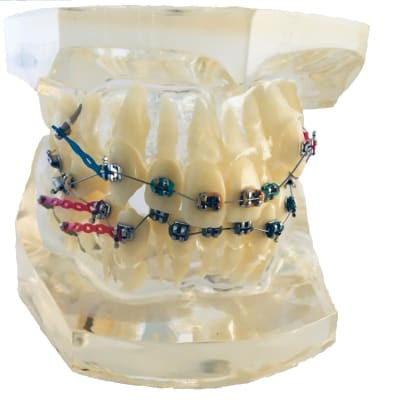 Modelo Ortodoncia con tratamiento Bracket, metálicos