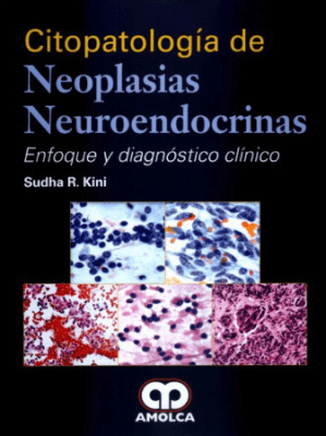 Kini  Citopatologia De Neoplasias Neuroendocrinas