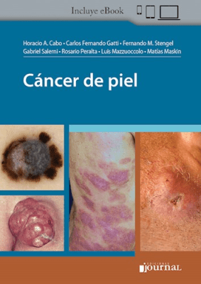 Cabo, Cáncer de Piel
