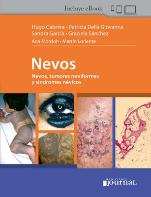 Nevos, Hugo Cabrera