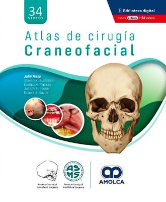 Atlas de Cirugía Craneofacial (Incluye 34 Videos) Mesa