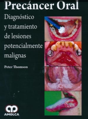 Thomson - Precancer Oral / Diagnostico y tratamiento de lesiones potencialmente malignas1