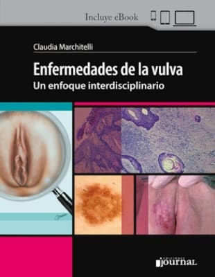 Enfermedades de la Vulva: Un enfoque interdisciplinario - Marchitelli