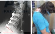 Cirugia de la Deformidad de la Columna Cervical Ames, C. - Riew, K2