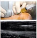 Plasma Rico en Plaquetas en Ortopedia y  Medicina Deportiva - Anitua, E.3