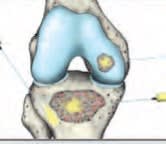 Plasma Rico en Plaquetas en Ortopedia y  Medicina Deportiva - Anitua, E.2
