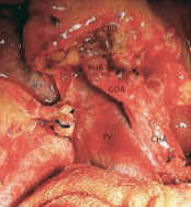 Cancer Pancreatico, Neoplasias Quisticas y Tumores Endocrinos. Diagnostico y Manejo  - Beger6