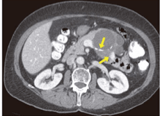 Cancer Pancreatico, Neoplasias Quisticas y Tumores Endocrinos. Diagnostico y Manejo  - Beger5