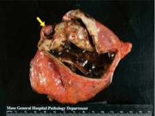 Cancer Pancreatico, Neoplasias Quisticas y Tumores Endocrinos. Diagnostico y Manejo  - Beger4