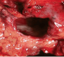 Cancer Pancreatico, Neoplasias Quisticas y Tumores Endocrinos. Diagnostico y Manejo  - Beger2