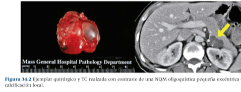 Cancer Pancreatico, Neoplasias Quisticas y Tumores Endocrinos. Diagnostico y Manejo  - Beger3