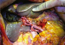 Cancer Pancreatico, Neoplasias Quisticas y Tumores Endocrinos. Diagnostico y Manejo  - Beger7