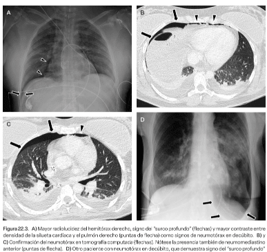 Insuficiencia respiratoria y ventilación mecánica, Gullermo Bugedo6