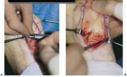 Chang Técnicas Quirúrgicas en Pie y Tobillo5