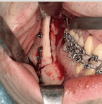 Manual ilustrado de cirugía oral (4ª edición)2