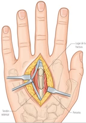 Chung, Reconstruccion de Mano y Extremidad Superior4
