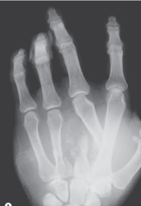 Chung, Reconstruccion de Mano y Extremidad Superior3