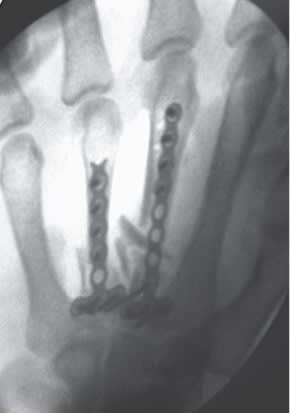 Chung, Reconstruccion de Mano y Extremidad Superior2