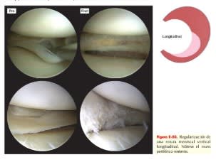 Tratado COT rodilla 5.12
