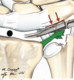 DEL PIÑAL, Atlas de Fracturas Distales de Radio.5