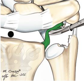 DEL PIÑAL, Atlas de Fracturas Distales de Radio.4