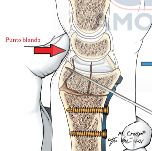 DEL PIÑAL, Atlas de Fracturas Distales de Radio.3