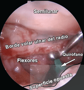 DEL PIÑAL, Atlas de Fracturas Distales de Radio.2