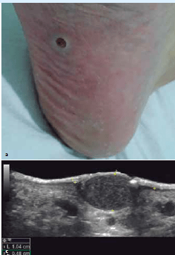Ecografia Dermatologica Ximena Wortsman4