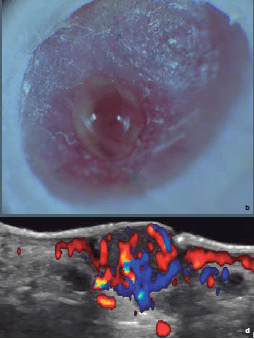 Ecografia Dermatologica Ximena Wortsman5