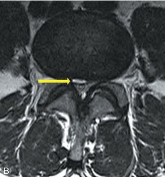 Diagnostico, Manejo y Tratamiento del Dolor Discogenico - Kapural3