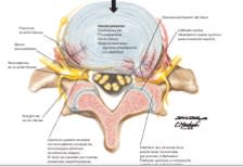 Diagnostico, Manejo y Tratamiento del Dolor Discogenico - Kapural1