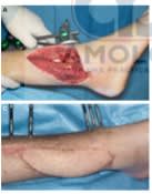 Cirugia Reconstructiva de la Extremidad Inferior 2 Vols - Pu, Lee4