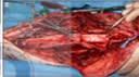 Cirugia Reconstructiva de la Extremidad Inferior 2 Vols - Pu, Lee2