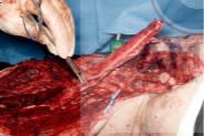 Cirugia Reconstructiva de la Extremidad Inferior 2 Vols - Pu, Lee1