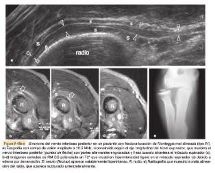 Bianchi Martinoli Ecografía Musculoesquelética 2 vols4