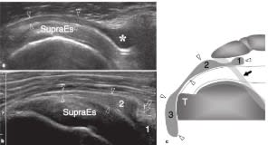 Bianchi Martinoli Ecografía Musculoesquelética 2 vols2