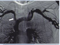 Radiología vascular intervencionista para hemodiálisis - Medina4