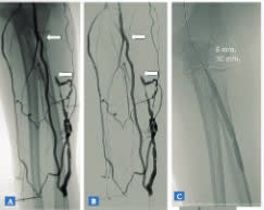 Radiología vascular intervencionista para hemodiálisis - Medina2