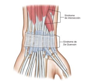 Miller Ortopedia en Medicina Deportiva. DeLee y Brez, 2 Vols. + Acceso Online5
