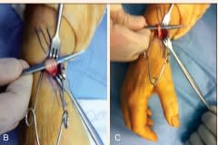 Miller Ortopedia en Medicina Deportiva. DeLee y Brez, 2 Vols. + Acceso Online4