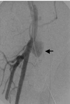 Radiología vascular intervencionista para hemodiálisis - Medina3