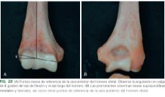 MORREY, Diagnostico Quirurgico del Codo, Cubito, Radio y Humero. Tecnicas Avanzadas de Morrey, 5e4